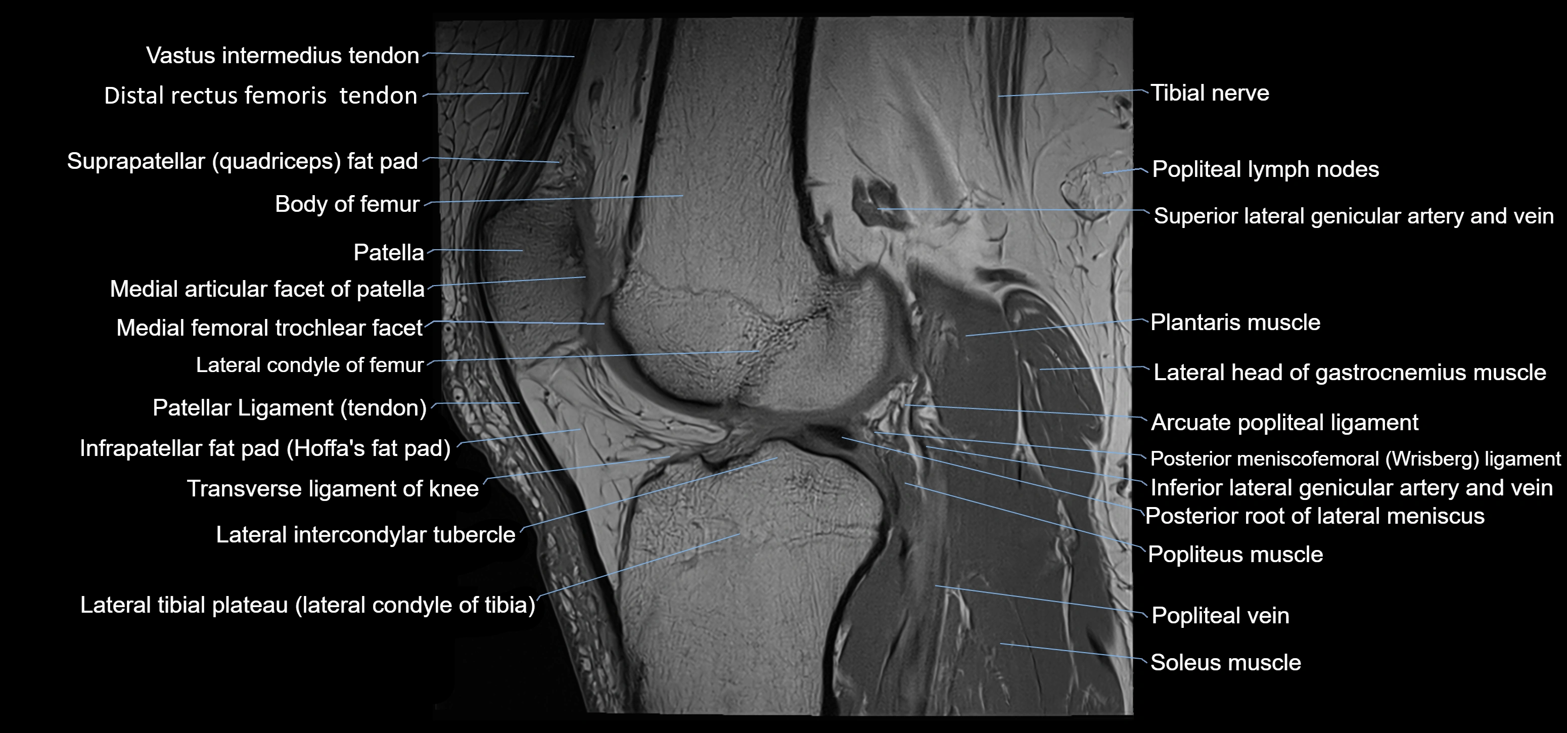 MRI knee sagittal cross sectional anatomy labelled 3T radiology image-00028.webp